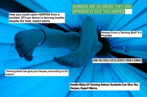 can you get herpes from a sunbed