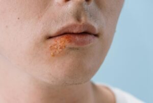 a cold sore on the edge of the lip